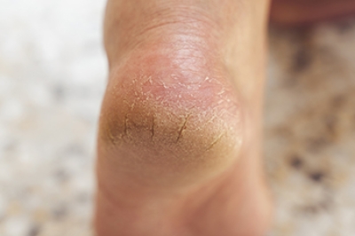 Why Skin Fissures Cause Cracked Heels