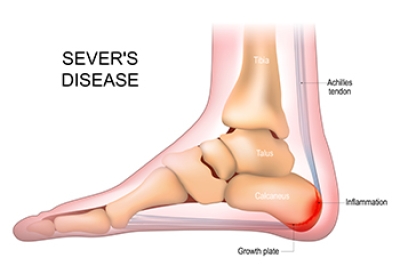 What Is Sever’s Disease?